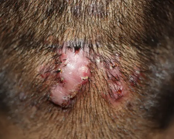 Lesión cutánea inflamada con pelos incrustados, similar a granos en el cuello, en la nuca.