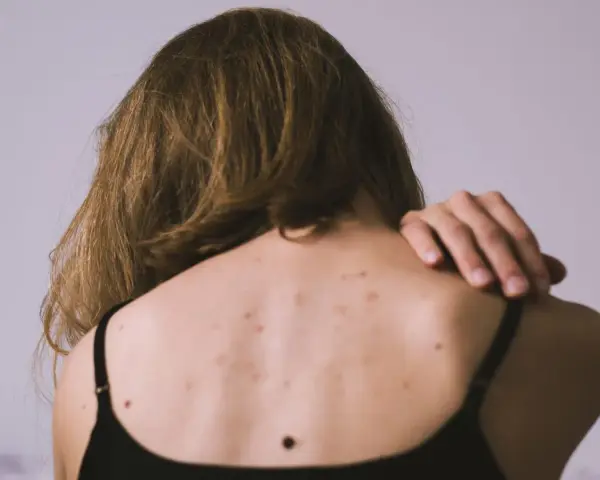 Vista posterior de una persona con granos en la espalda, algunos lunares y cabello castaño.
