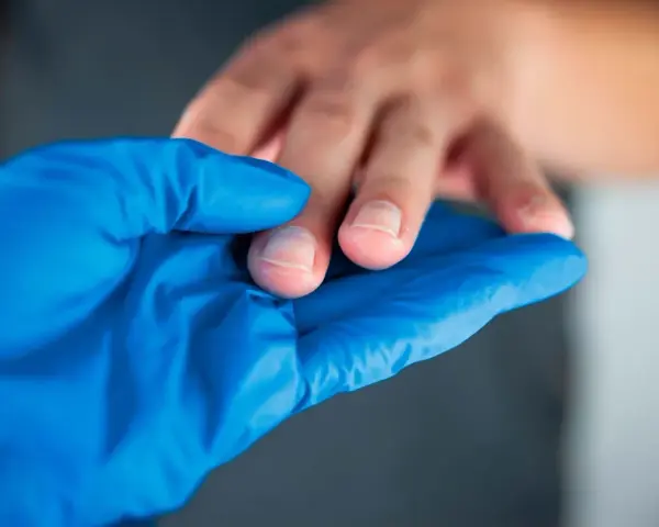 Manos con callos, examinadas con guante azul.