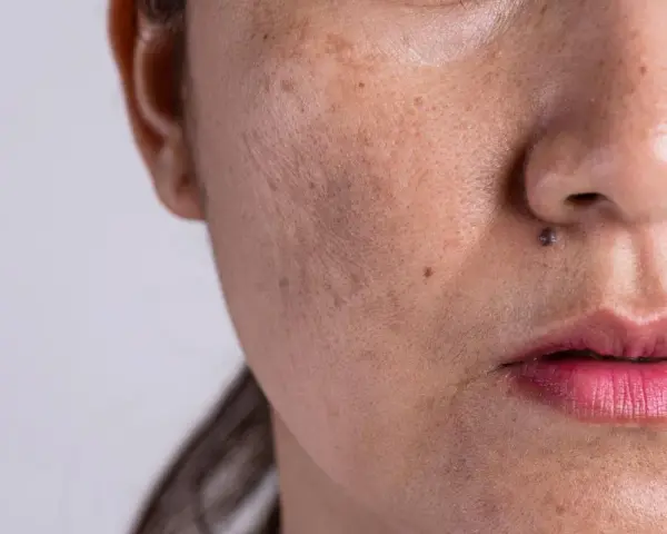 Primer plano de una cara con melasma y un pequeño lunar que parece un bigote.