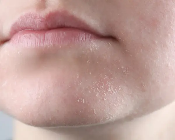 Primer plano de labios agrietados y piel seca cara con escamas visibles.