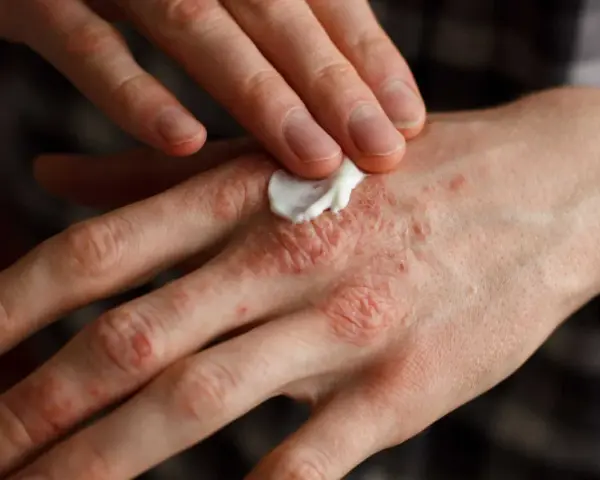 Persona aplica crema en sus manos afectadas por psoriasis, buscando alivio para la piel irritada.