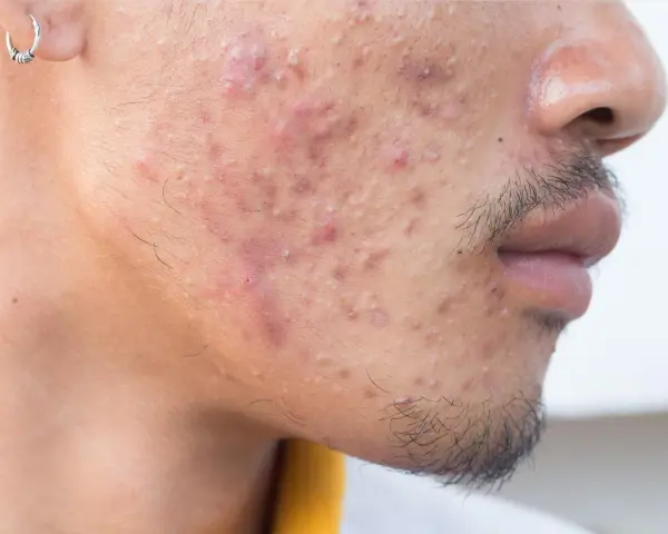 Primer plano de un rostro con acné severo. Se observa una oreja con un pendiente. El ácido hialurónico es bueno para el acné, ayudando a hidratar y calmar la piel.