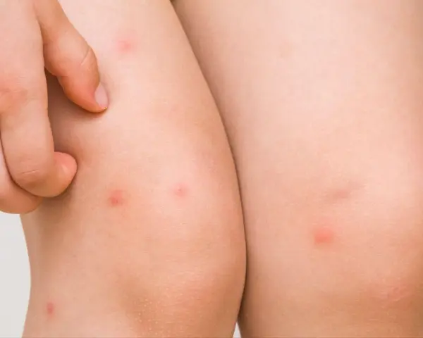 Un niño se rasca un sarpullido en las piernas. Se ven varias picaduras rojas y elevadas en la piel.