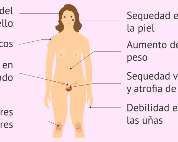 Ilustración de síntomas de menopausia: caída de cabello, sofocos, sequedad de piel, aumento de peso, etc. Testimonios menopausia.