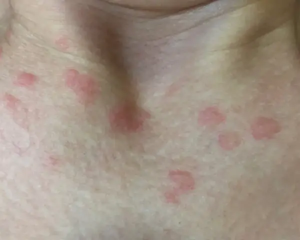 Primer plano de la piel del cuello y el pecho con varias ronchas rojas, algunas agrupadas y otras dispersas.