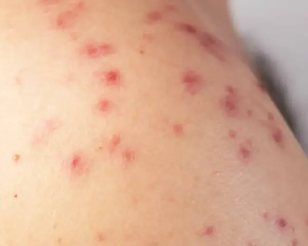 Primer plano de sarpullidos en la piel, con pequeñas protuberancias rojas y algunas marcas de acné.