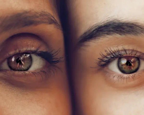 Primer plano de dos ojos, uno con ojeras vasculares pronunciadas, el otro con piel clara y sin ellas.