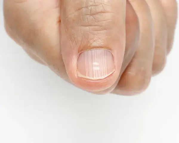 Uña con estrias verticales, mostrando la textura y posibles irregularidades.