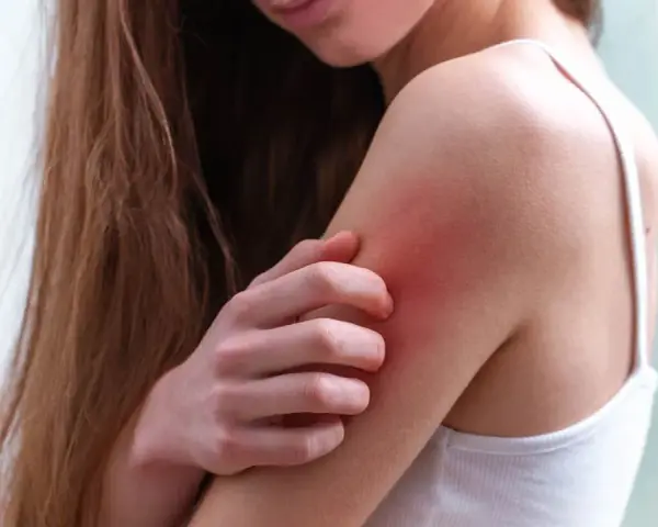 Una persona se rasca el brazo, con la piel enrojecida por los granos por sudor.