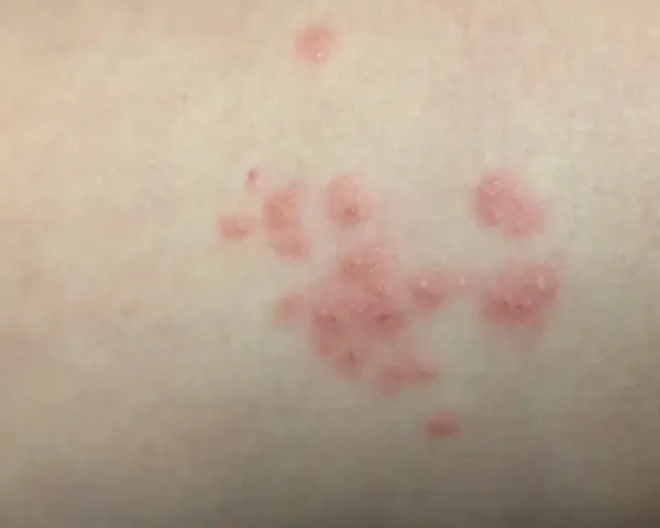 Manchas rosadas en la piel sin picor, agrupadas en racimos.