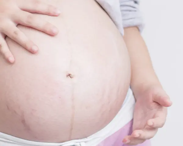Barriga de embarazada con estrías moradas, un signo de la vida que crece.