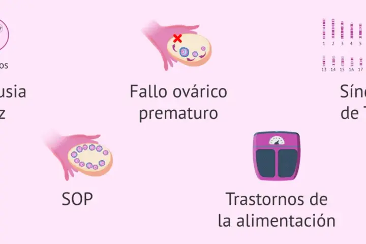 Ilustración sobre menopausia precoz, fallo ovárico, SOP, síndrome de Turner y trastornos alimentarios, causas de falta de estrógenos remedios naturales.