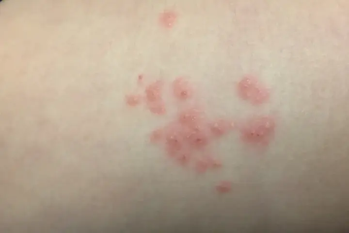 Manchas rosadas en la piel sin picor, agrupadas en racimos.