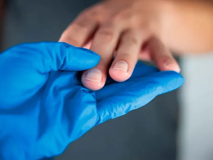 Manos con callos, examinadas con guante azul.