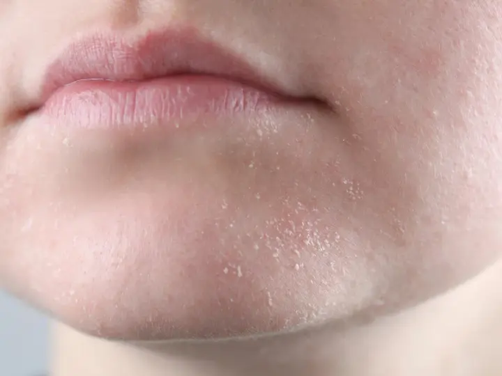 Primer plano de labios agrietados y piel seca cara con escamas visibles.