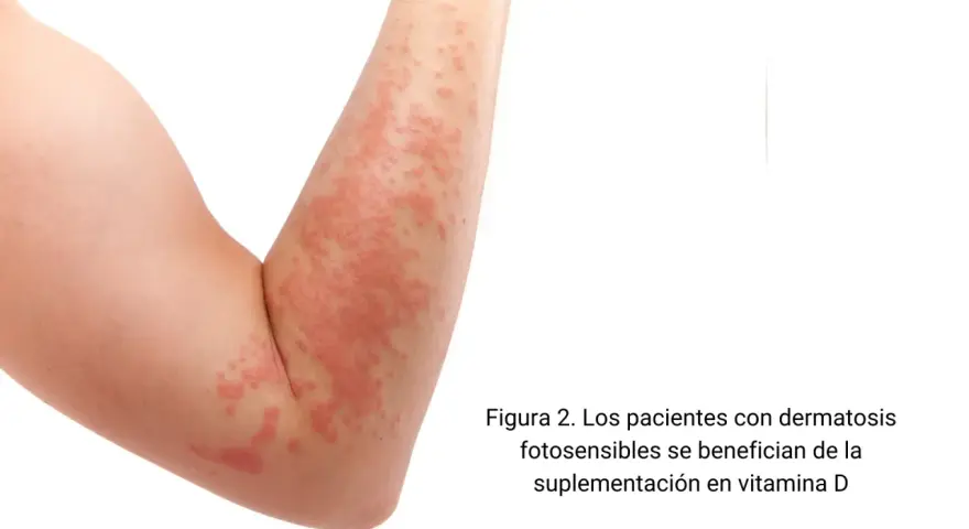 Brazo con erupción cutánea roja y elevada. La vitamina D es clave para la salud de la piel, especialmente para quienes sufren de dermatosis fotosensibles.