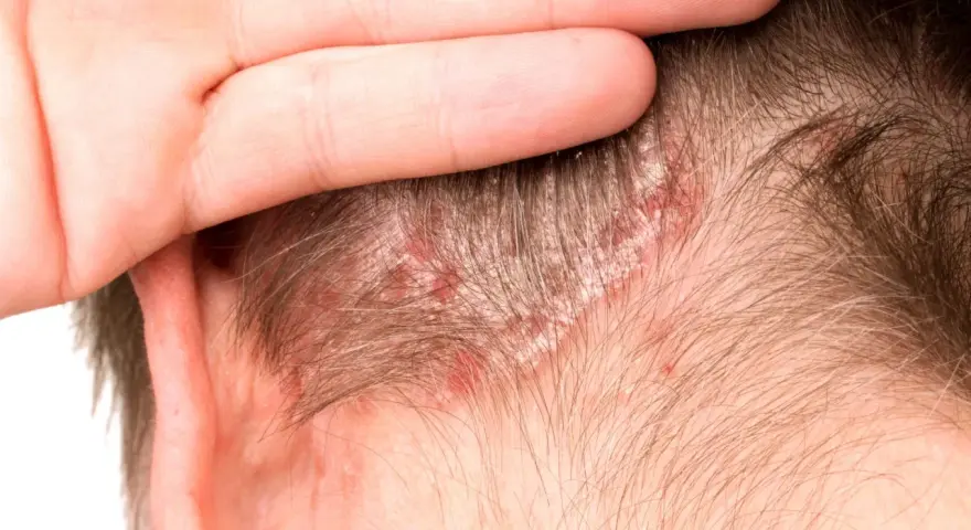 Una mano cubre parte de la cabeza, revelando parches rojos y escamosos en el cuero cabelludo, indicativos de dermatitis seborreica.