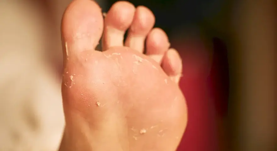 Piel descamada en el pie, indicando posibles tipos de hongos en los pies y cómo curarlos.