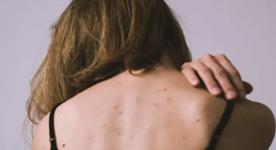 Vista posterior de una persona con granos en la espalda, algunos lunares y cabello castaño.
