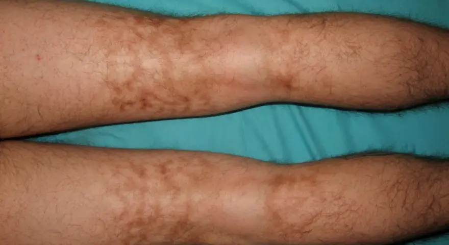 Piernas con manchas marrones irregulares y vello oscuro.