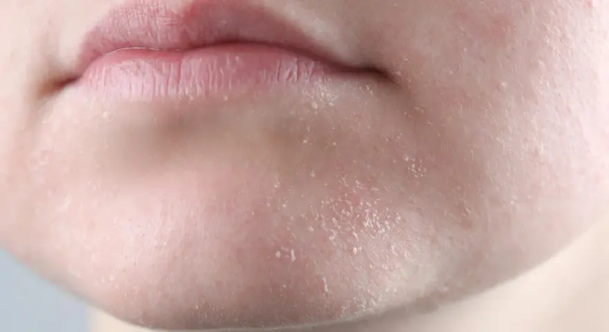 Primer plano de labios agrietados y piel seca cara con escamas visibles.