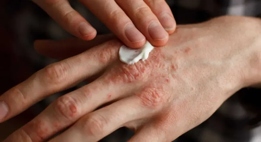 Persona aplica crema en sus manos afectadas por psoriasis, buscando alivio para la piel irritada.