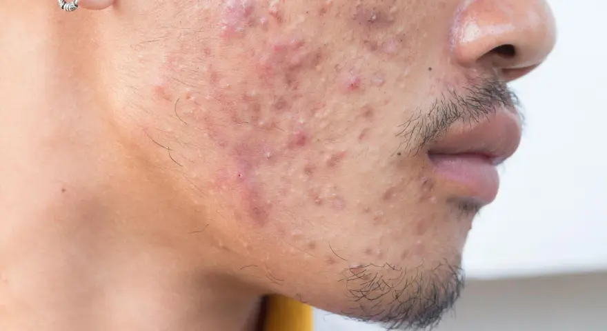 Primer plano de un rostro con acné severo. Se observa una oreja con un pendiente. El ácido hialurónico es bueno para el acné, ayudando a hidratar y calmar la piel.