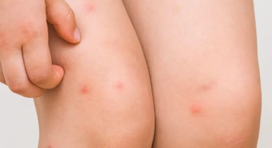 Un niño se rasca un sarpullido en las piernas. Se ven varias picaduras rojas y elevadas en la piel.