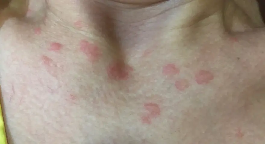 Primer plano de la piel del cuello y el pecho con varias ronchas rojas, algunas agrupadas y otras dispersas.