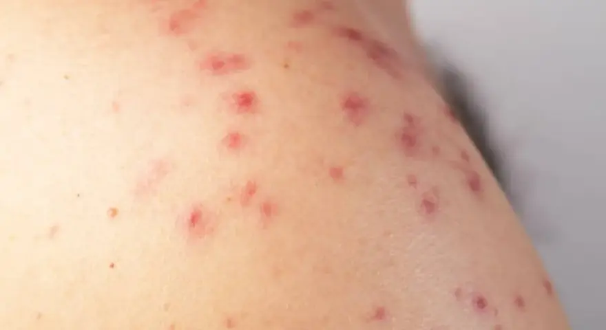 Primer plano de sarpullidos en la piel, con pequeñas protuberancias rojas y algunas marcas de acné.