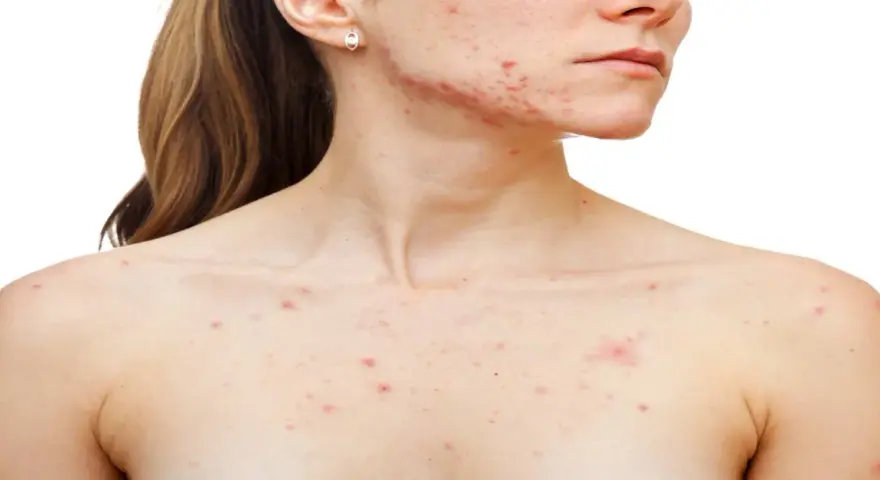 Persona con granos en el pecho y rostro, mostrando la afectación de la piel por acné.