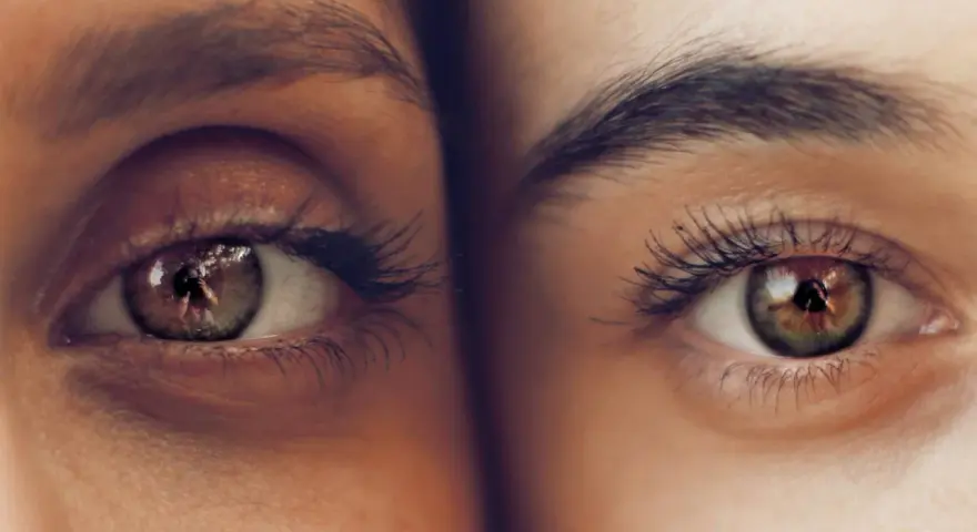 Primer plano de dos ojos, uno con ojeras vasculares pronunciadas, el otro con piel clara y sin ellas.