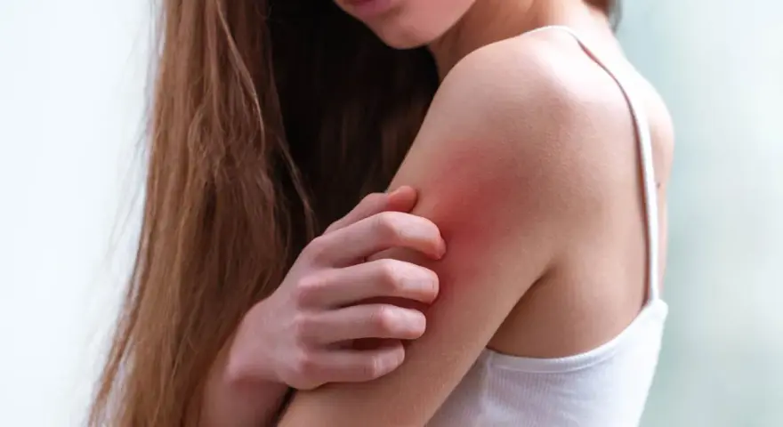 Una persona se rasca el brazo, con la piel enrojecida por los granos por sudor.