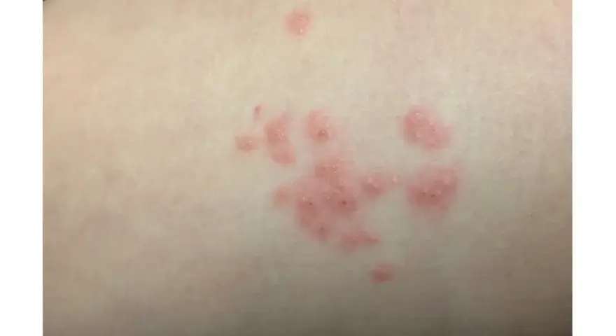 Manchas rosadas en la piel sin picor, agrupadas en racimos.