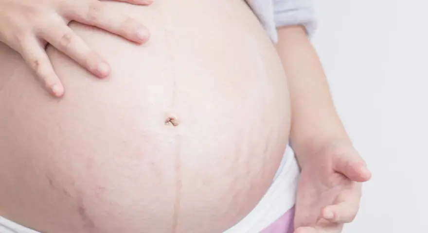 Barriga de embarazada con estrías moradas, un signo de la vida que crece.