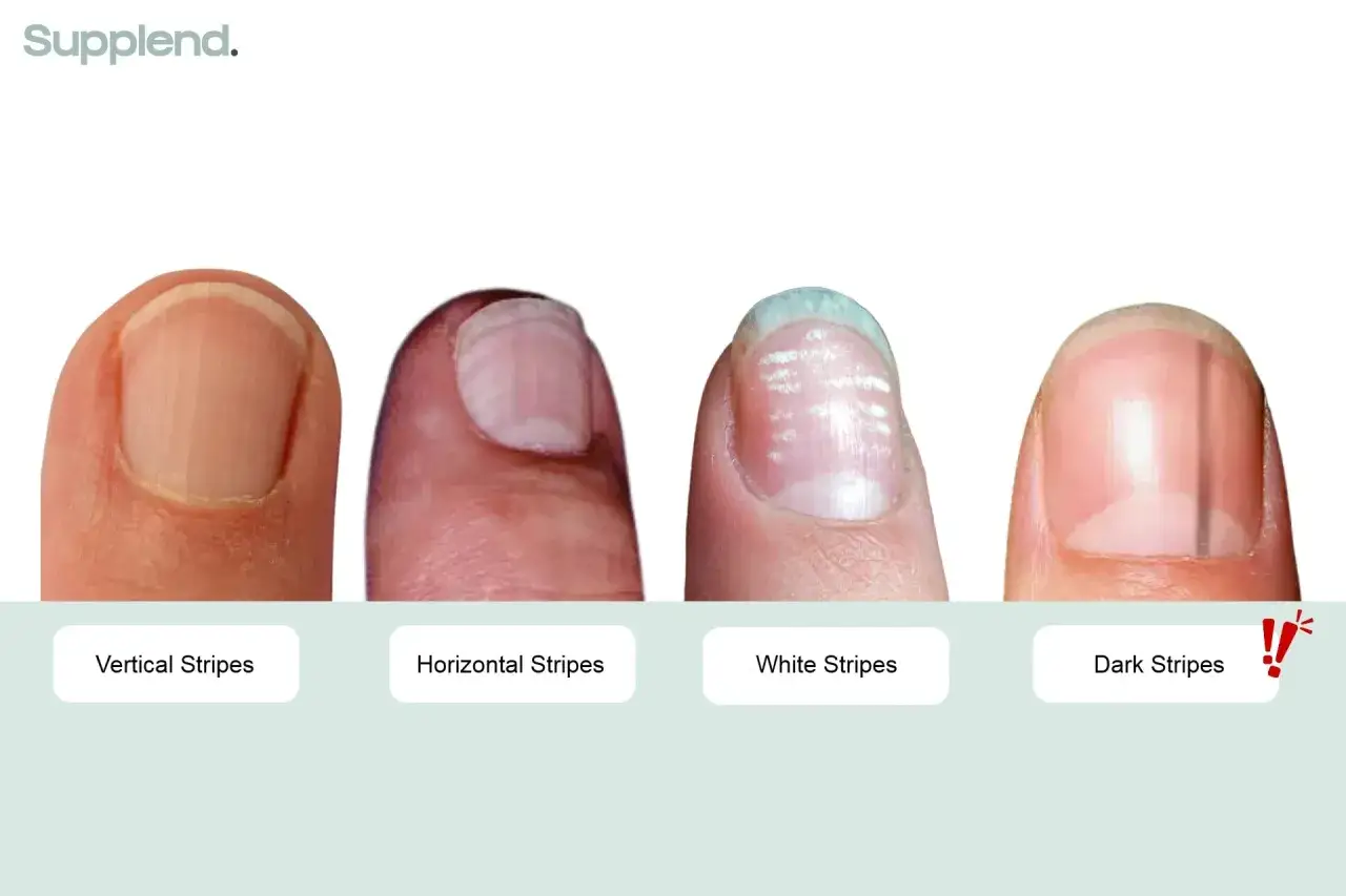 Cuatro uñas muestran diferentes tipos de estrías: verticales, horizontales, blancas y oscuras.