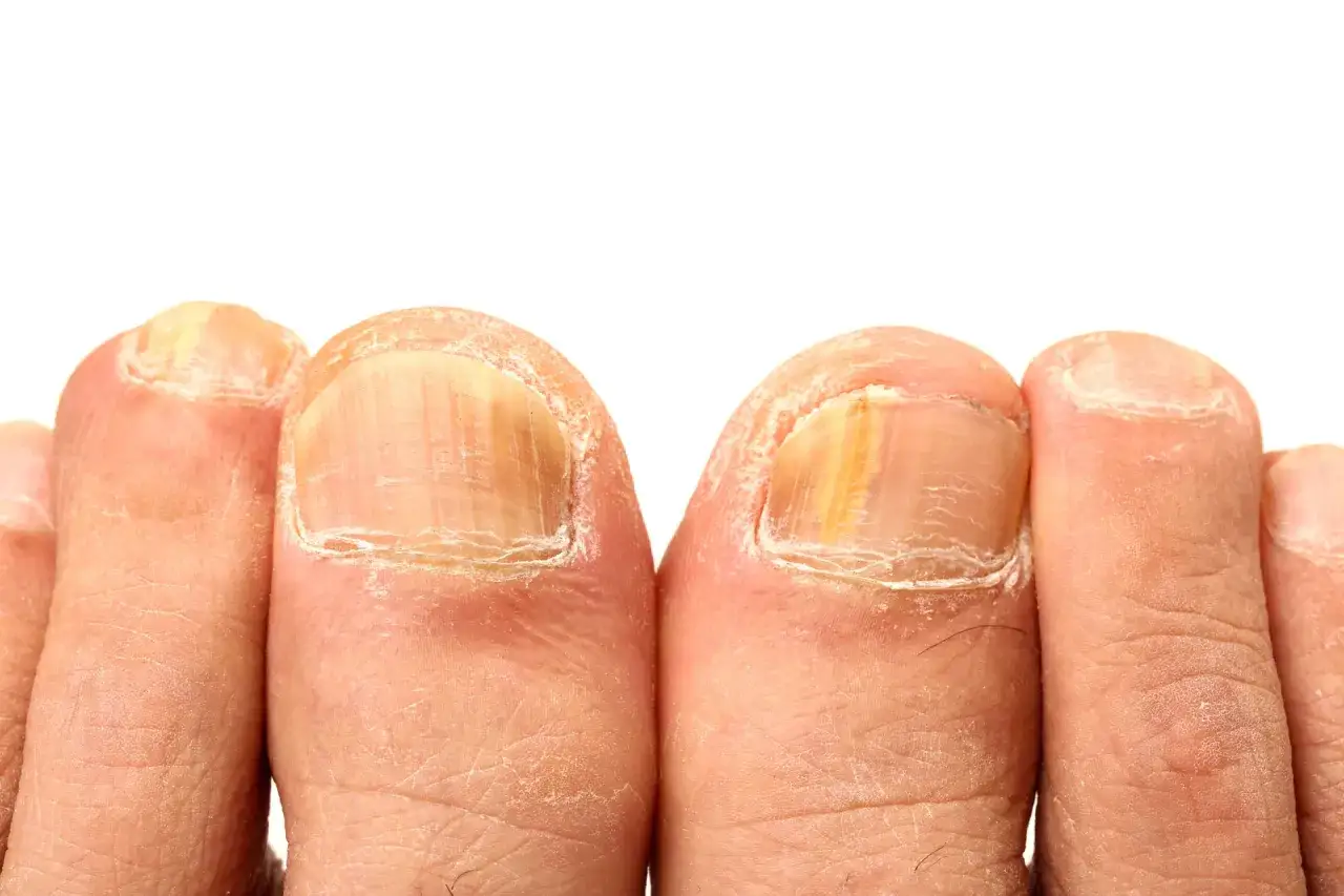 Dedos de los pies con u&ntilde;as engrosadas y amarillentas, indicando tipos de hongos en los pies y c&oacute;mo curarlos.