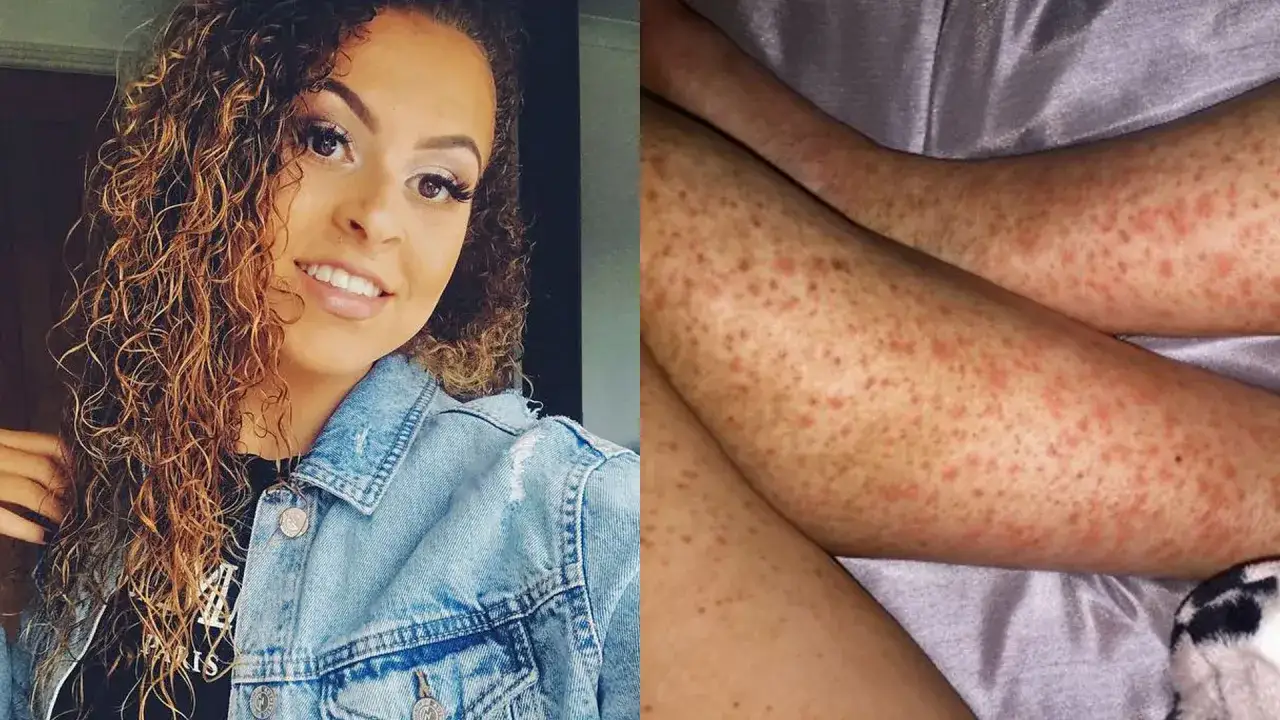 Joven sonriente con rizos y chaqueta vaquera, a su lado, sus piernas cubiertas de un sarpullido rojo.