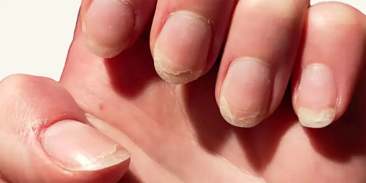Manos con uñas quebradizas y descamadas, mostrando la necesidad de regenerar uñas dañadas para una apariencia saludable.