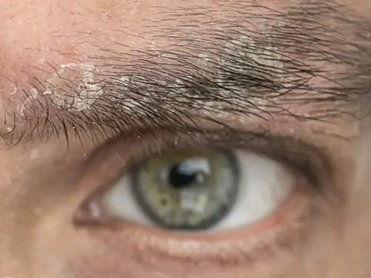Primer plano de un ojo con escamas blancas y piel irritada en la ceja, indicativo de dermatitis seborreica.