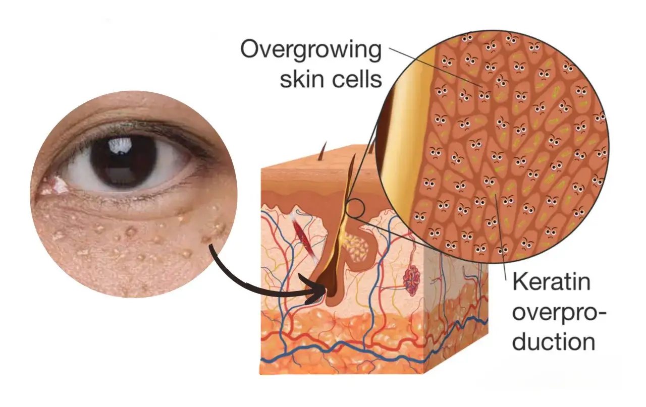 Primer plano de un ojo con pequeños granos por sudor en la piel. Una sección transversal de la piel muestra células cutáneas sobrecrecidas y queratina en exceso.