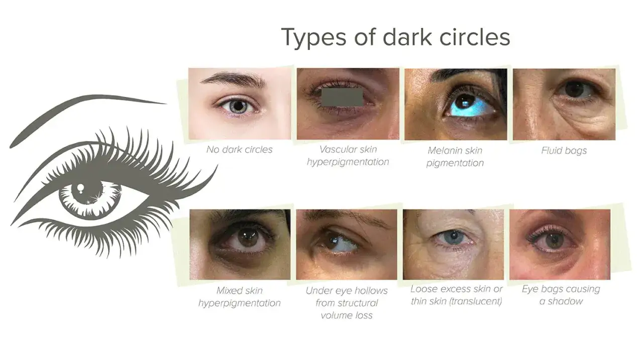 Comparaci&oacute;n de tipos de ojeras: piel vascular, pigmentaci&oacute;n, bolsas de fluidos y m&aacute;s.