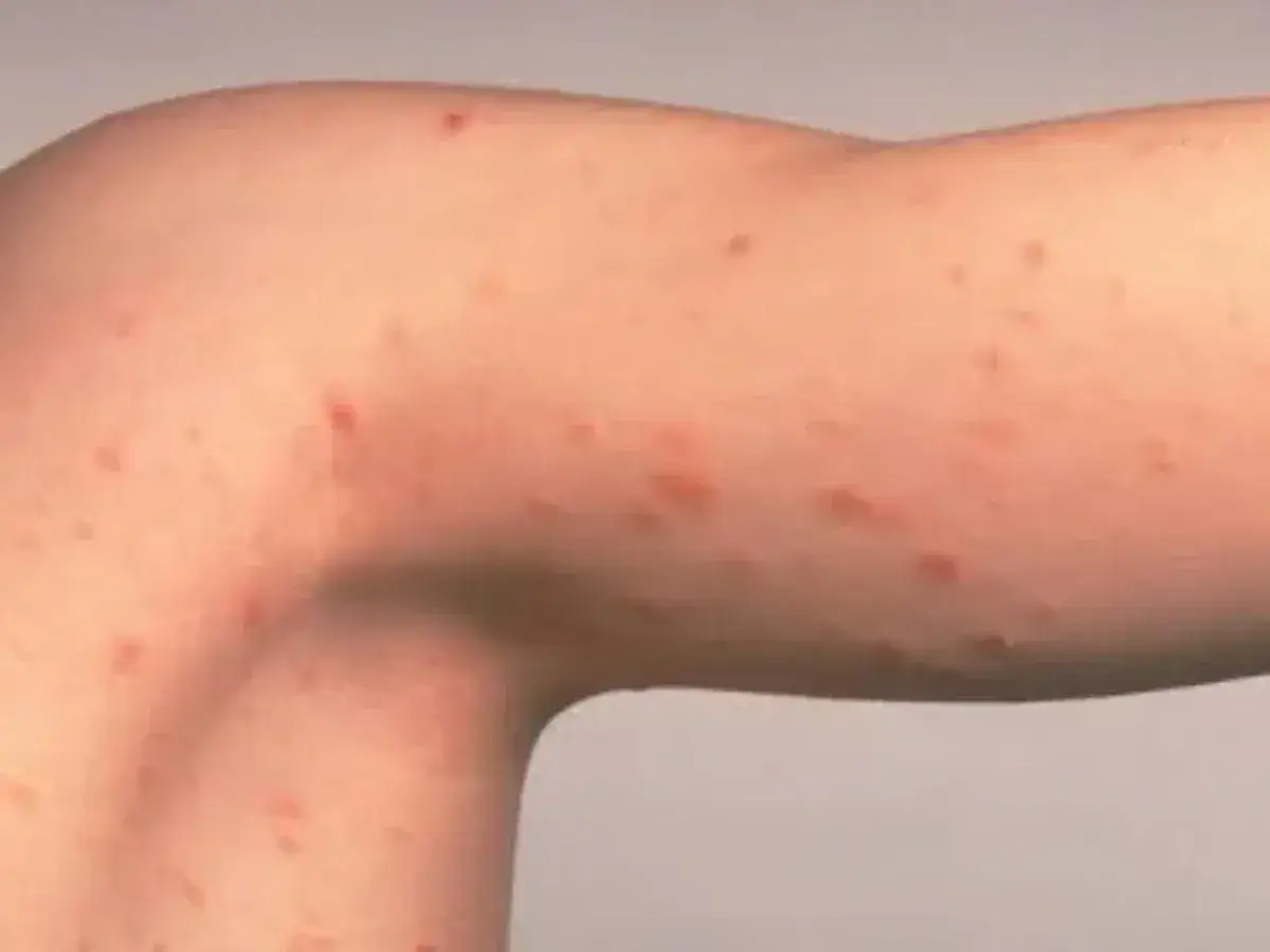 Brazo con manchas rosadas en la piel sin picor, como pequeños puntos rojos que cubren la superficie.
