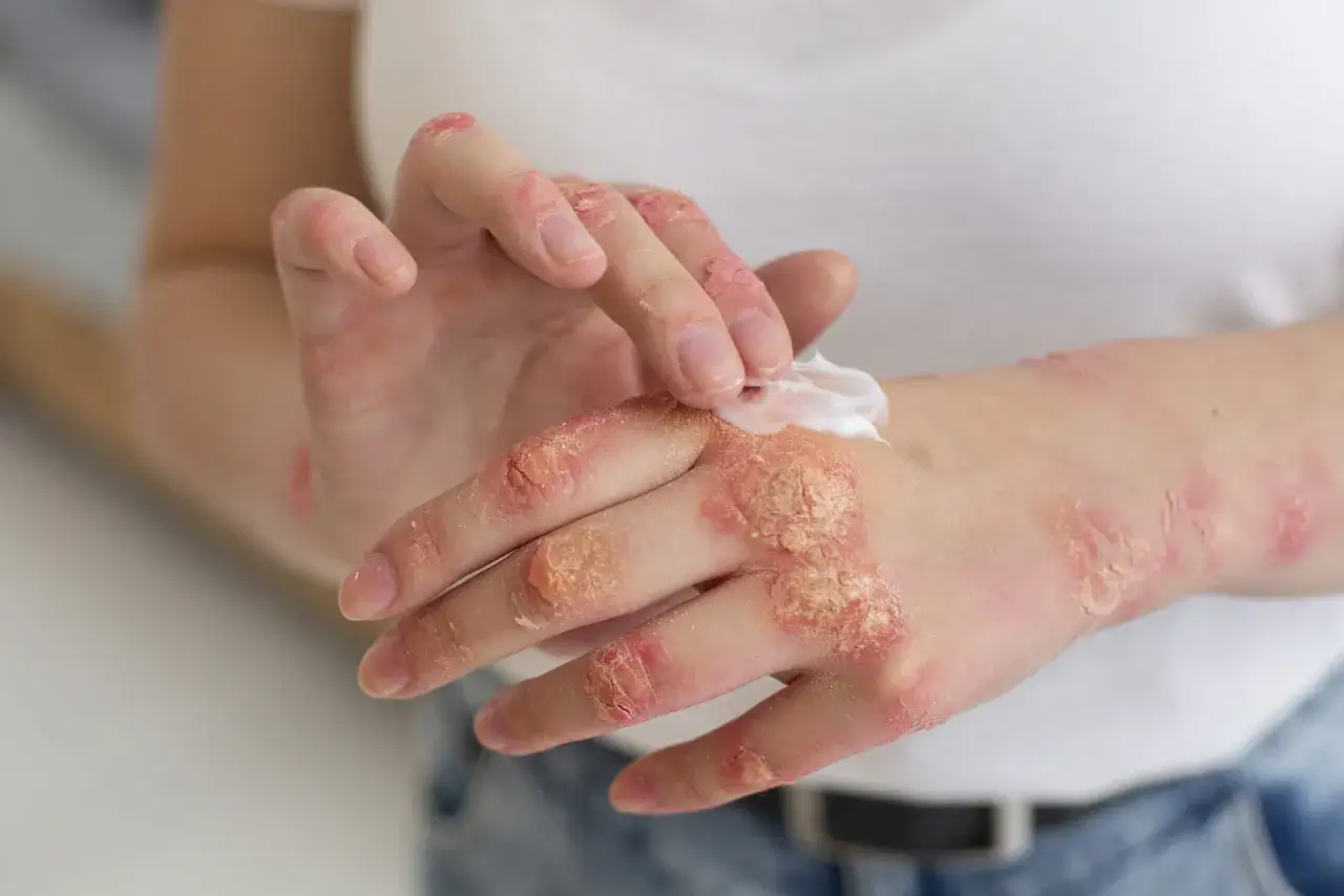 Manos con psoriasis, piel enrojecida y escamosa. Una persona aplica crema para aliviar la irritación.