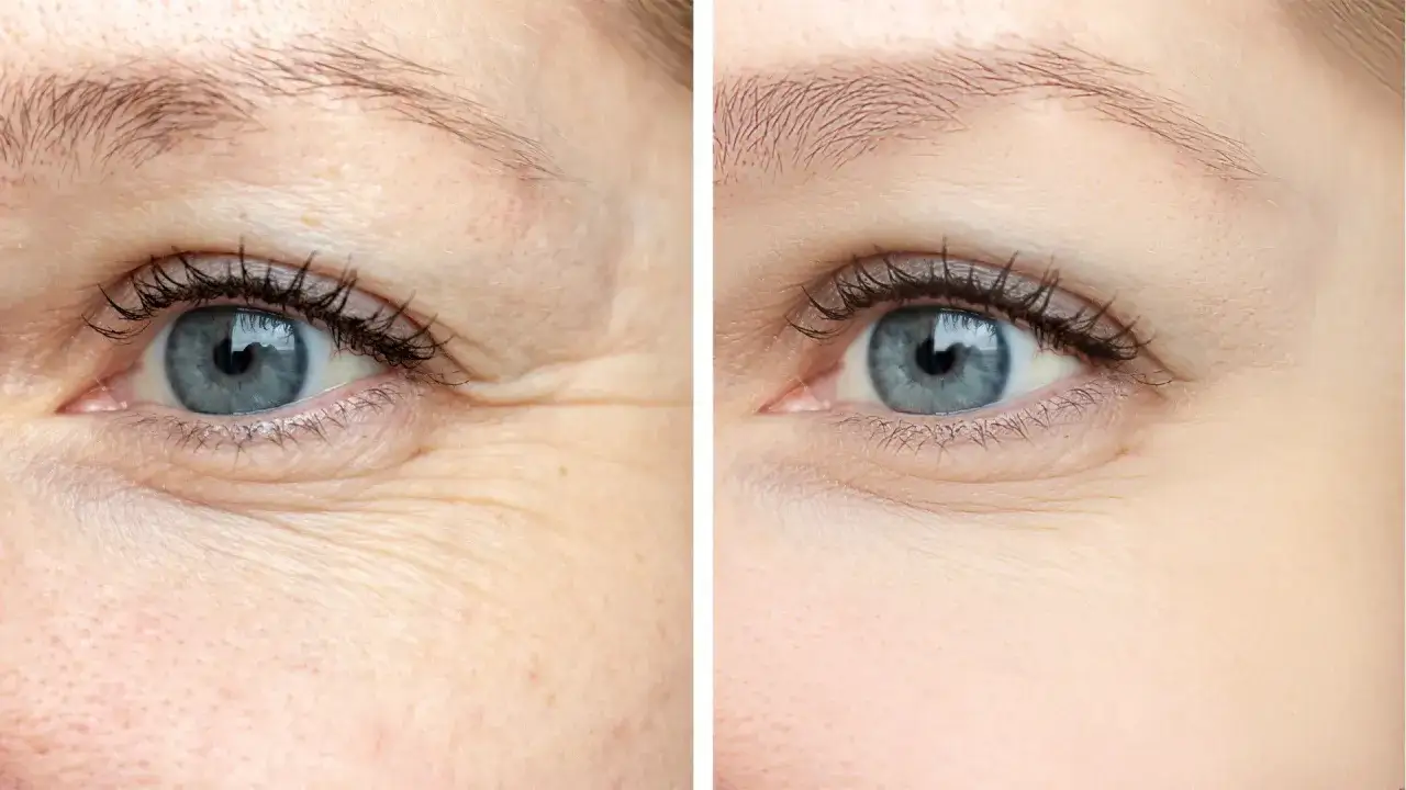 Ojo izquierdo con arrugas debajo de los ojos antes y después de un tratamiento.