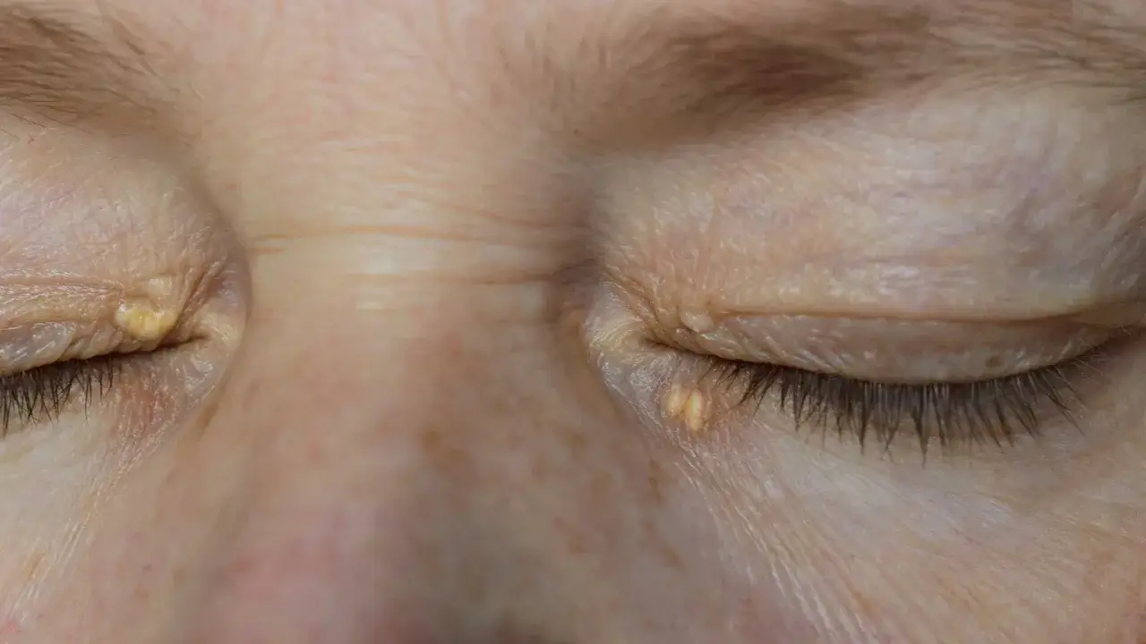 Ojos con xantelasmas amarillentos en los p&aacute;rpados. Se buscan cremas para eliminar xantelasmas y mejorar la apariencia.