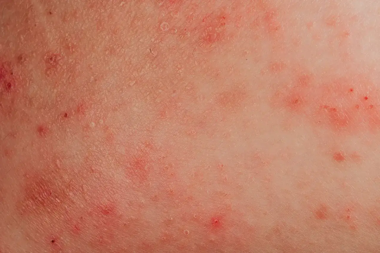 Primer plano de piel con múltiples ronchas rojas, algunas con pequeñas ampollas, indicando irritación o una reacción alérgica.