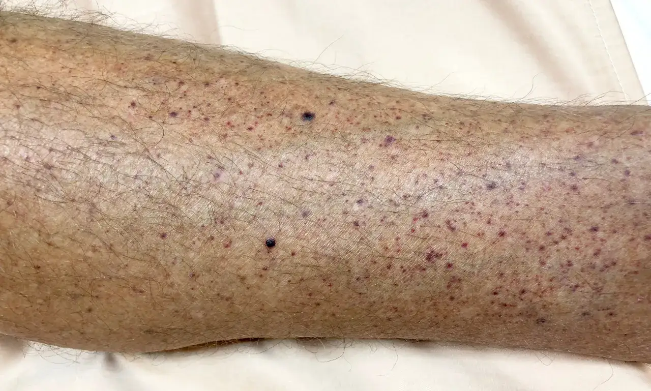 Piel con múltiples manchas pequeñas y oscuras, algunas de ellas moradas, cubriendo la pierna.