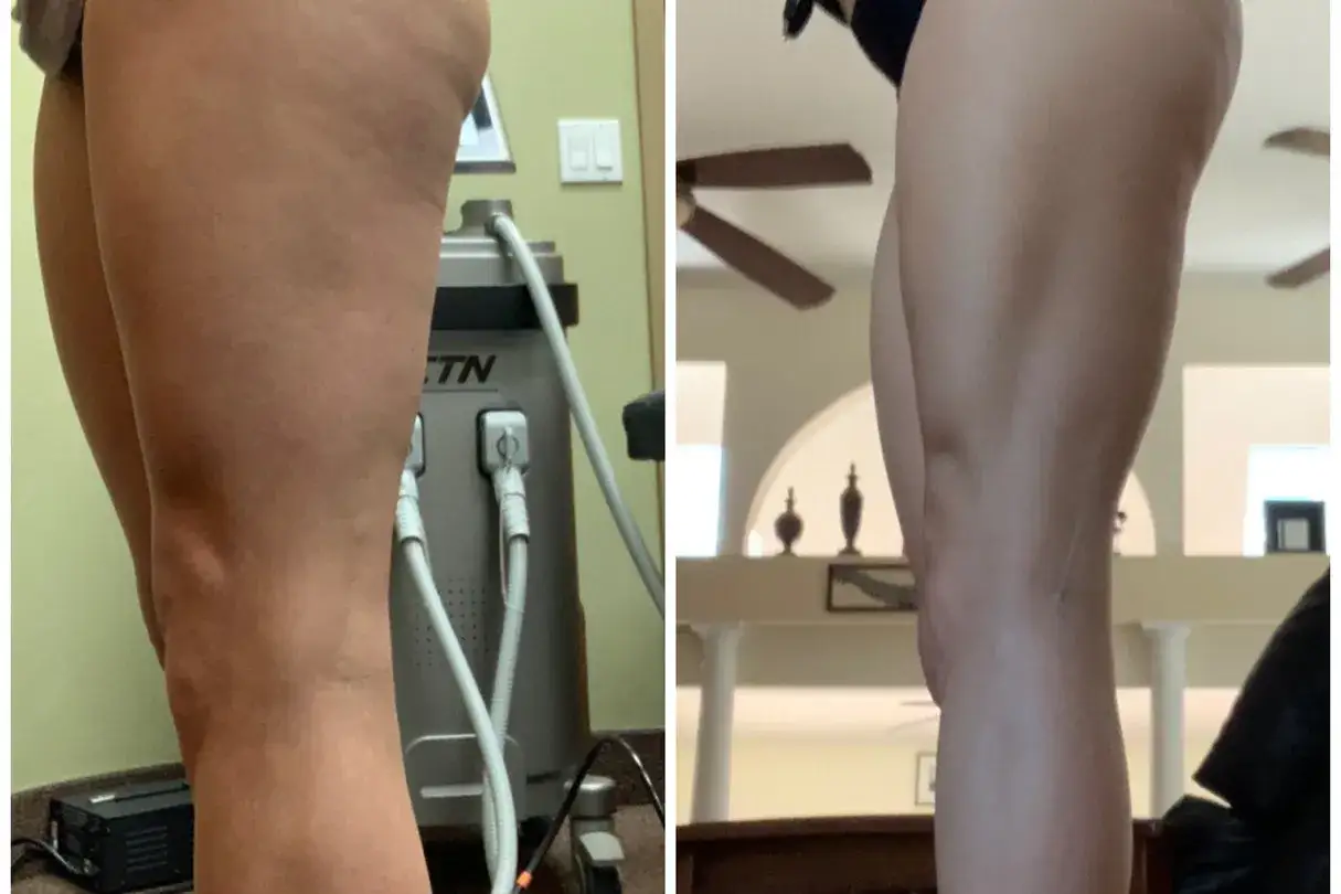 Antes y despu&eacute;s de un tratamiento para mejorar el sistema linf&aacute;tico, mostrando una reducci&oacute;n visible de la celulitis en los muslos.